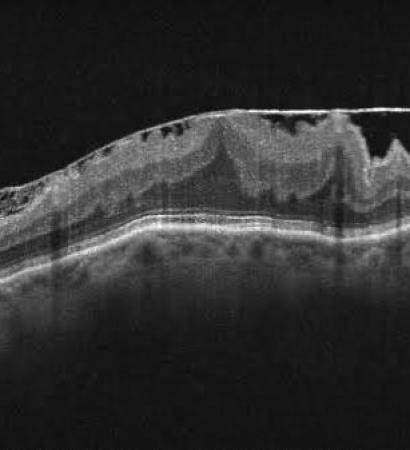 membrana-epiretiniana_03