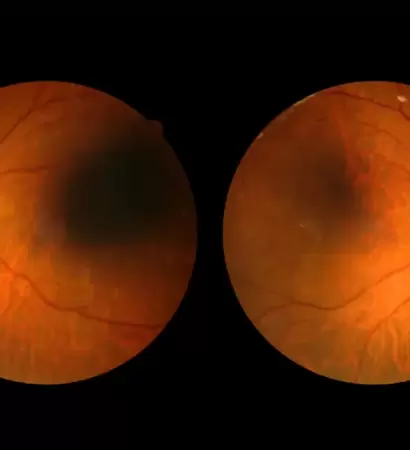 retinopatie01
